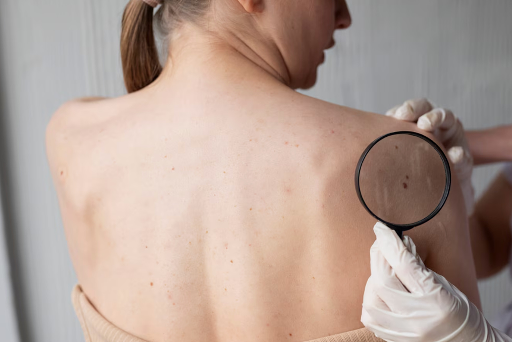 Atenção com o melanoma!